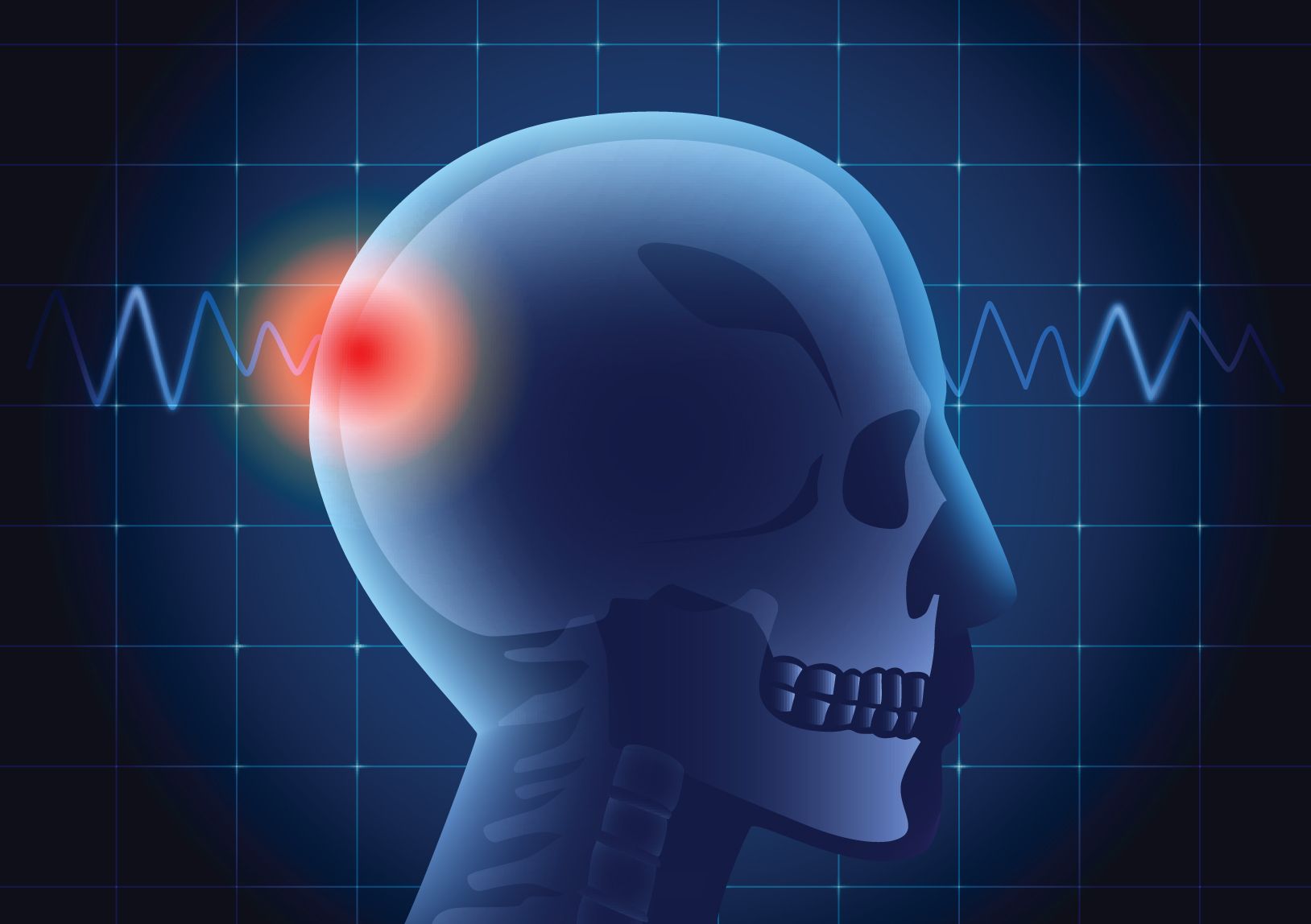 Third Occipital Nerve Block