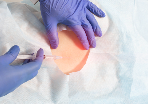 Epidural Steroid Injection